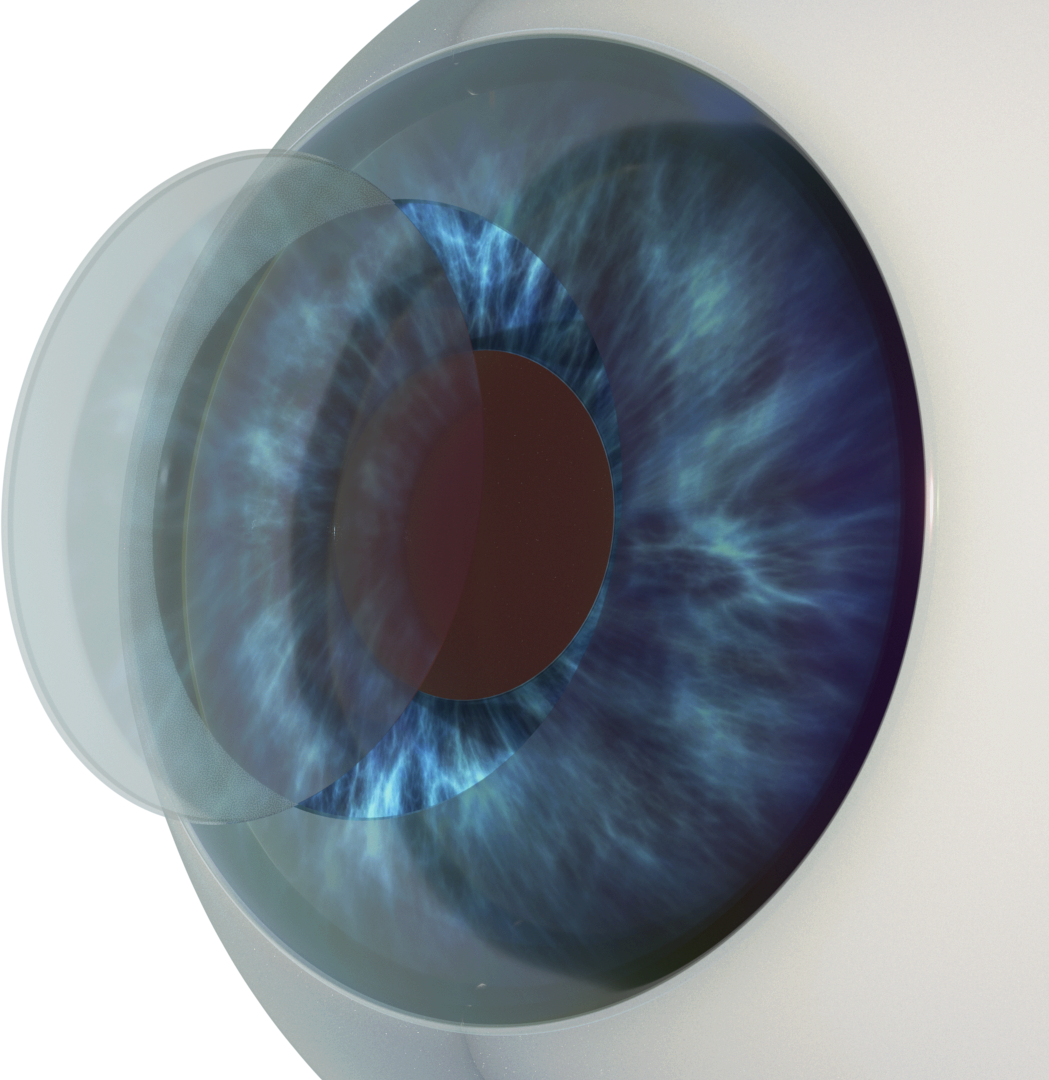 Refractive Surgeries